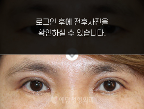 상안검수술