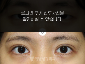 절개법 쌍꺼풀수술+앞트임