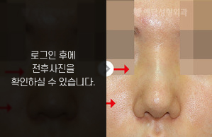 낮은코성형