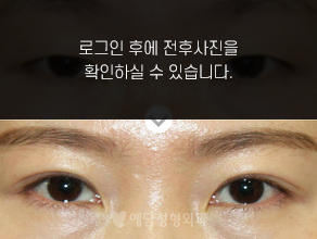절개법 쌍꺼풀수술