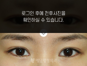 절개법 쌍꺼풀수술+앞트임