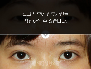 매몰법 쌍꺼풀수술