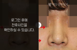 낮은코성형