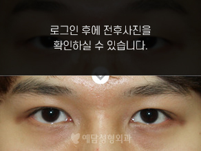 매몰법 쌍꺼풀수술