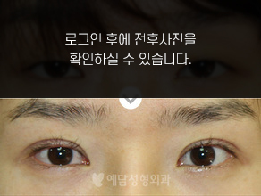 매몰법 쌍거풀수술