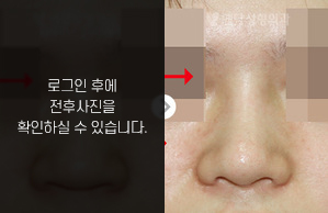 코재수술