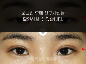 절개법 쌍꺼풀수술