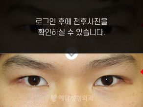 매몰법 쌍꺼풀수술