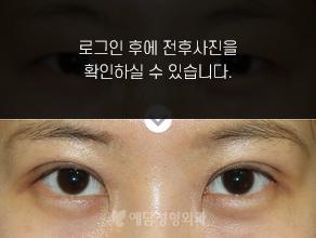 매몰법 쌍꺼풀수술