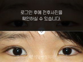 부분절개 쌍꺼풀수술