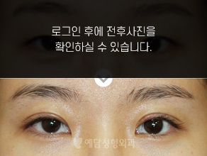 절개법 쌍꺼풀수술