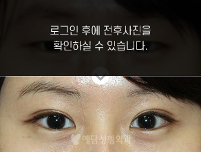 절개법 쌍꺼풀수술