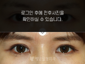 매몰법 쌍꺼풀수술