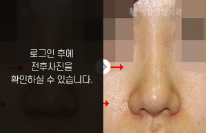 복코성형