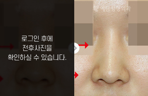 낮은코성형