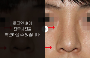 코재수술