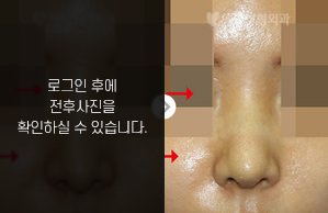 코재수술
