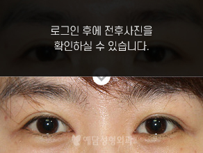 앞트임
