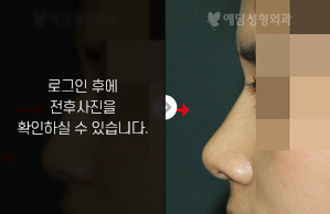 매부리코성형