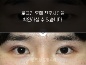 절개법 쌍꺼풀수술