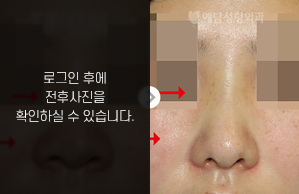 코재수술