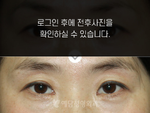 앞트임