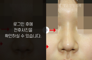 낮은코성형