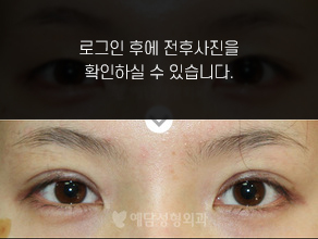 매몰법 쌍꺼풀수술