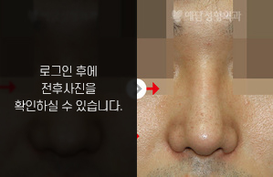 매부리코성형