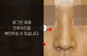 매부리코성형