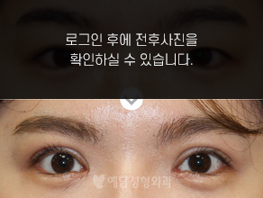 절개법 쌍꺼풀수술+앞트임