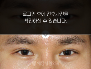 절개법 쌍꺼풀수술