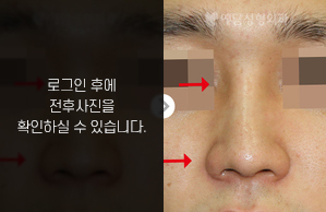 낮은코성형