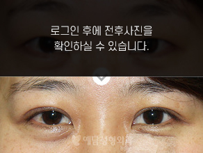 절개법 쌍꺼풀수술