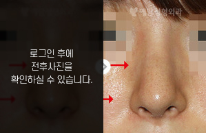 휜코성형