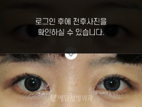 절개법 쌍꺼풀수술+앞트임