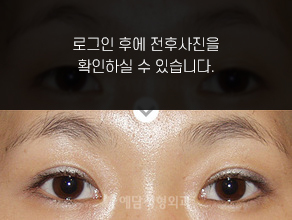절개법 쌍꺼풀수술