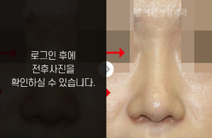 복코성형