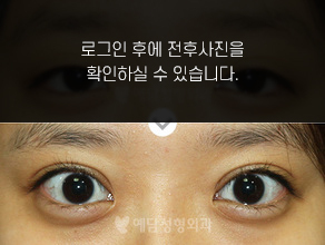 부분절개 쌍꺼풀수술