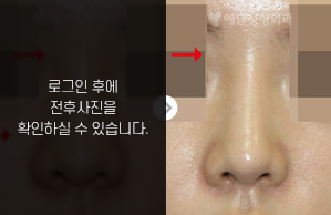 낮은코성형