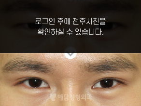 절개법 쌍꺼풀수술