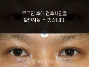 절개법 쌍꺼풀수술+앞트임