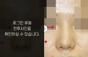 코재수술(보형물 비뚤어짐)