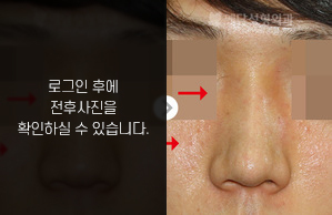 매부리코성형