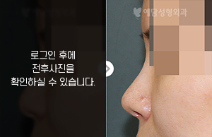 낮은코성형