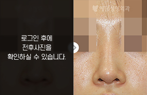 코재수술