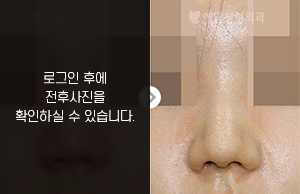 코끝수술(코끝 연골 묶기)