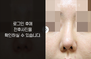 코재수술(코끝 연골 돌출 개선)
