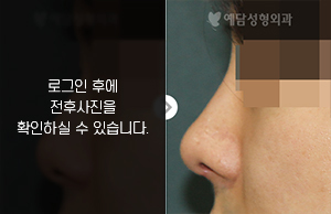 낮은코성형