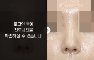 코재수술(초기구축 완화)